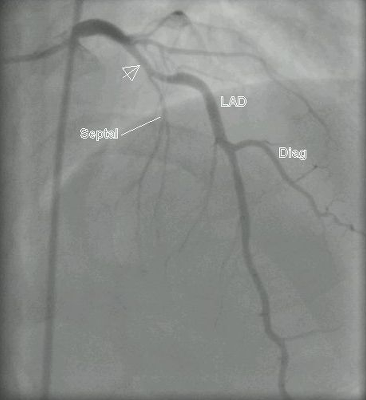 Left coronary angiogram in PA cranial view