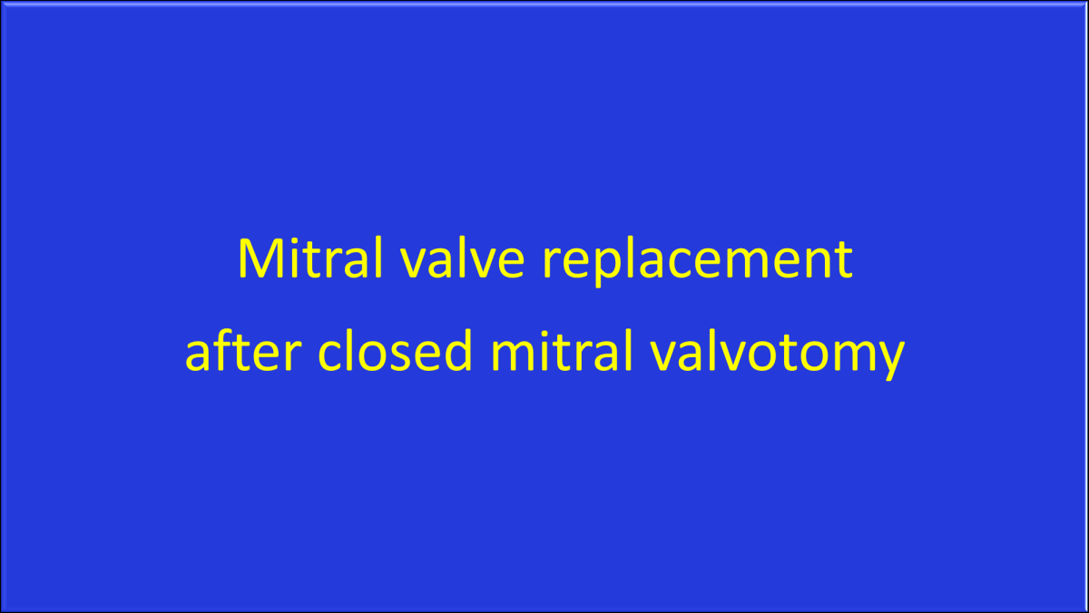 Mitral valve replacement after closed mitral valvotomy