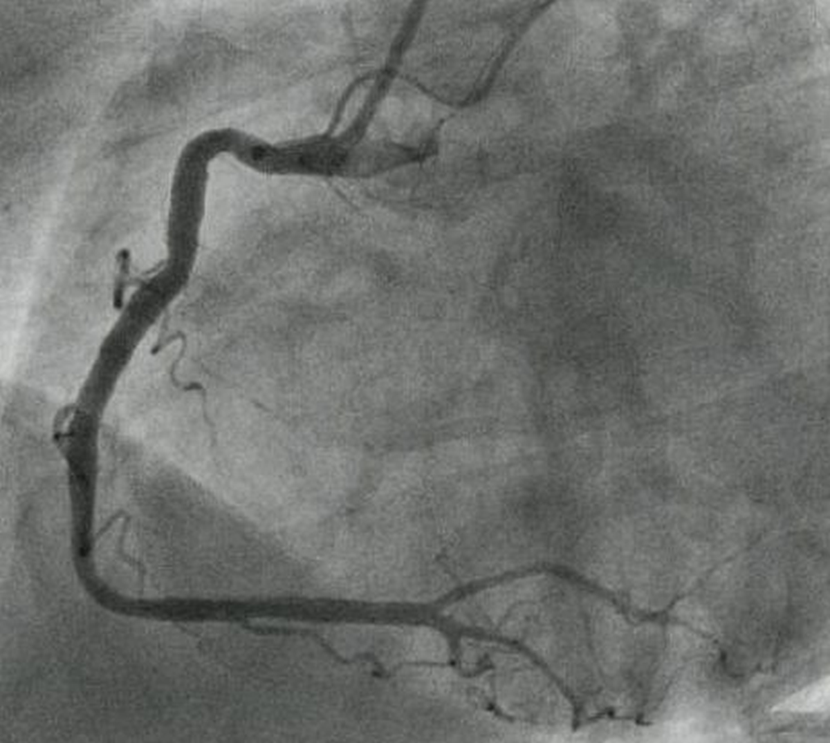 Right coronary angiogram in LAO view