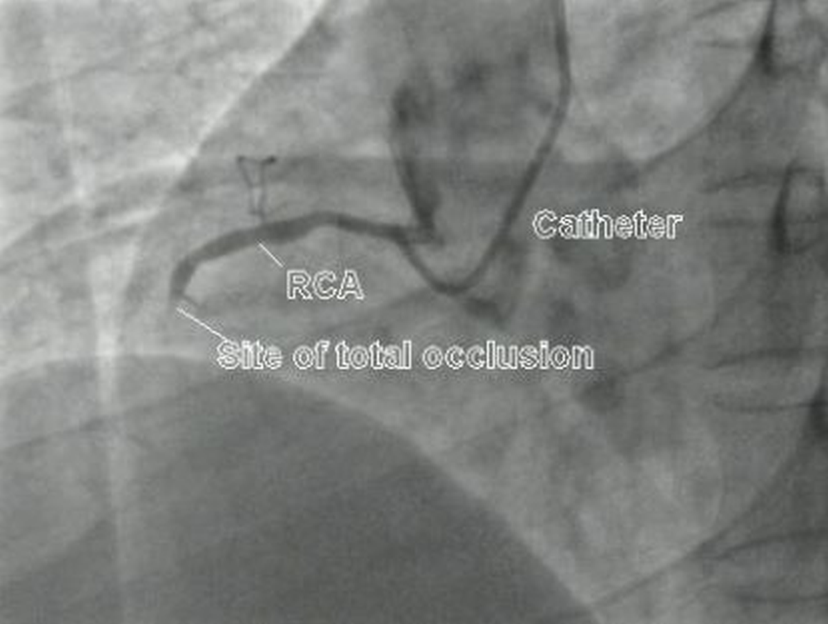 Total occlusion of right coronary artery