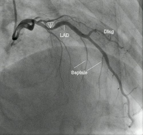 Left coronary angiogram in RAO cranial view