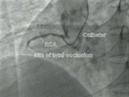 rca-total – All About Cardiovascular System and Disorders