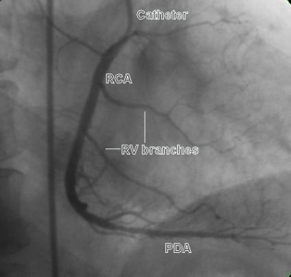 Right coronary artery showing right ventricular branches and posterior descending artery
