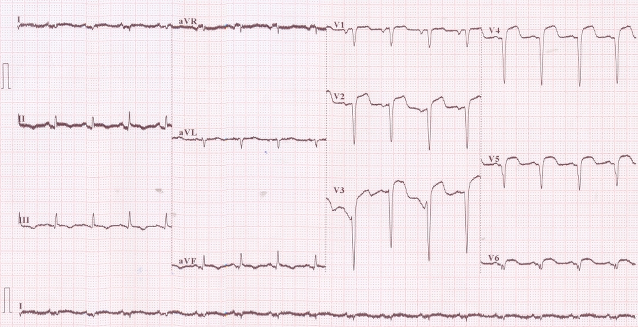 Anterior wall myocardial infarction and 50 Hz interference