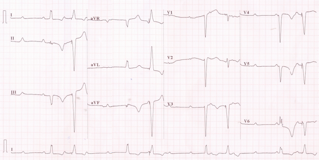 Complete heart block and intermittent pacing