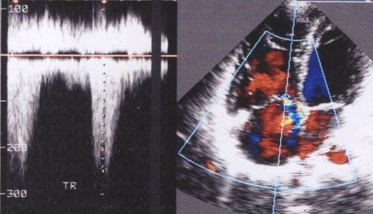 Estimation of right ventricular systolic pressure by Doppler echocardiography