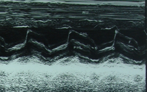 Mitral stenosis - M mode