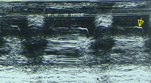 Pulmonary valve M-Mode echocardiogram in mitral stenosis with pulmonary hypertension