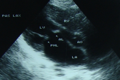 Mitral stenosis - parasternal long axis view