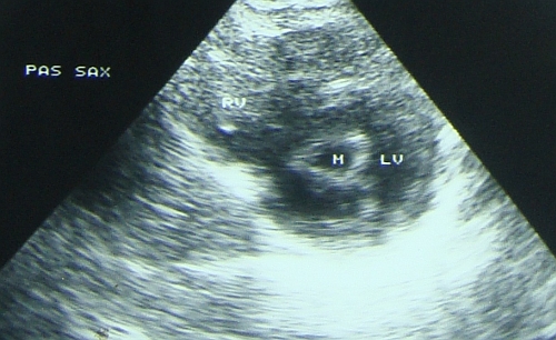 Fish mouth appearance in mitral stenosis on echocardiogram