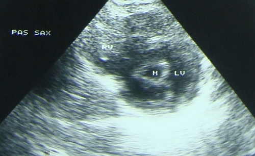 Mitral stenosis - parasternal short axis view