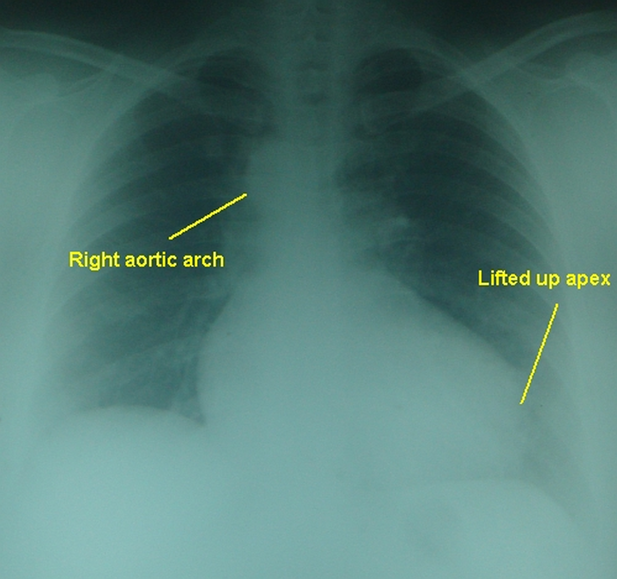 Tetralogy Of Fallot Right Aortic Arch All About Cardiovascular System And Disorders