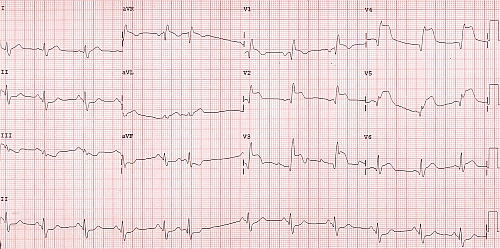 Acute anterior wall myocardial infarction with RBBB