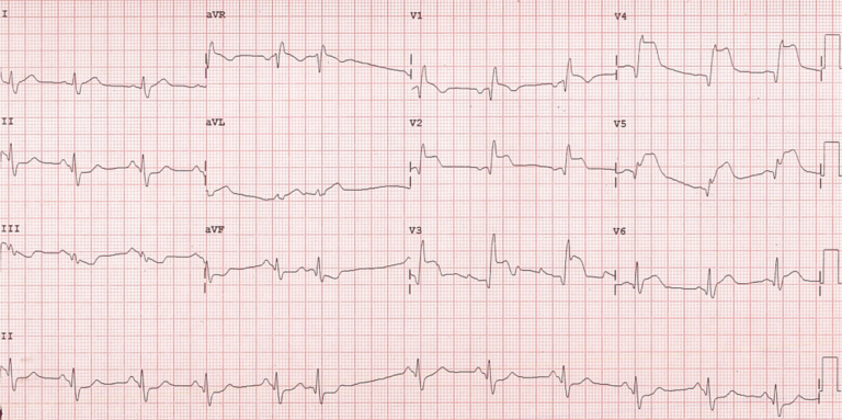 anterior-wall-myocardial-infarction-definition-doctorvisit