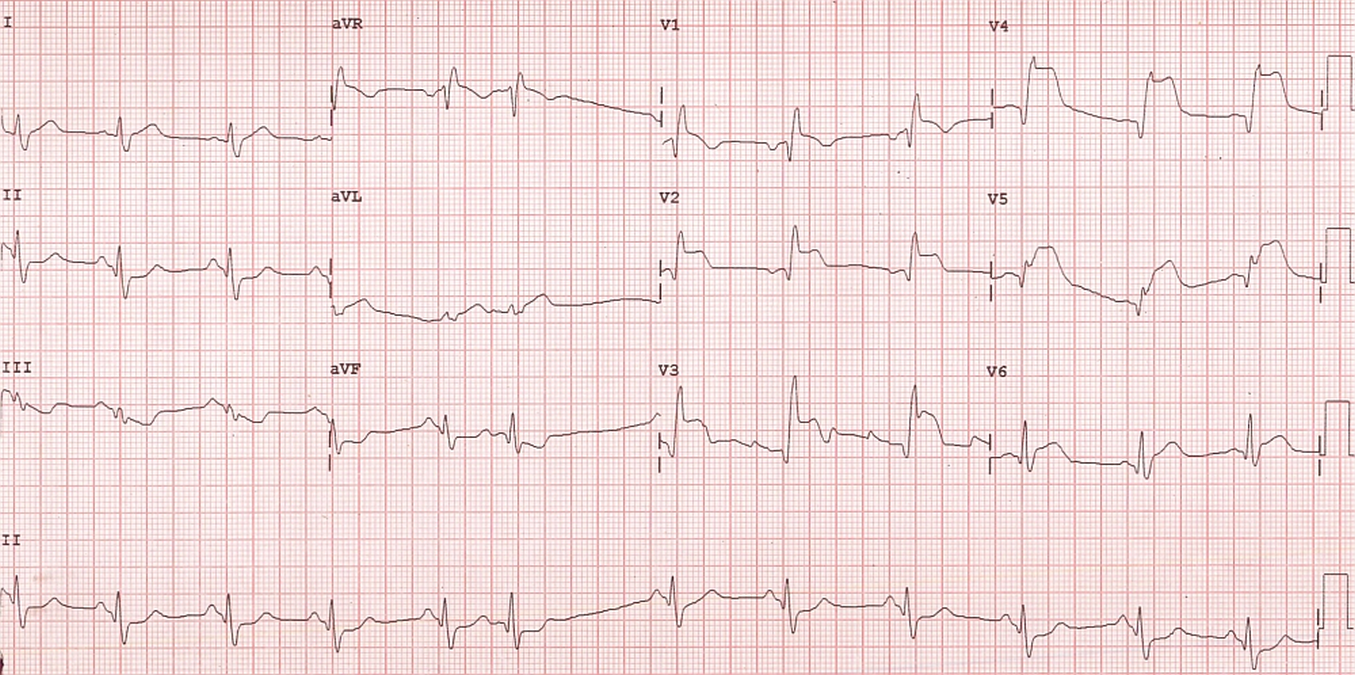 Acute anterior wall myocardial infarction with RBBB