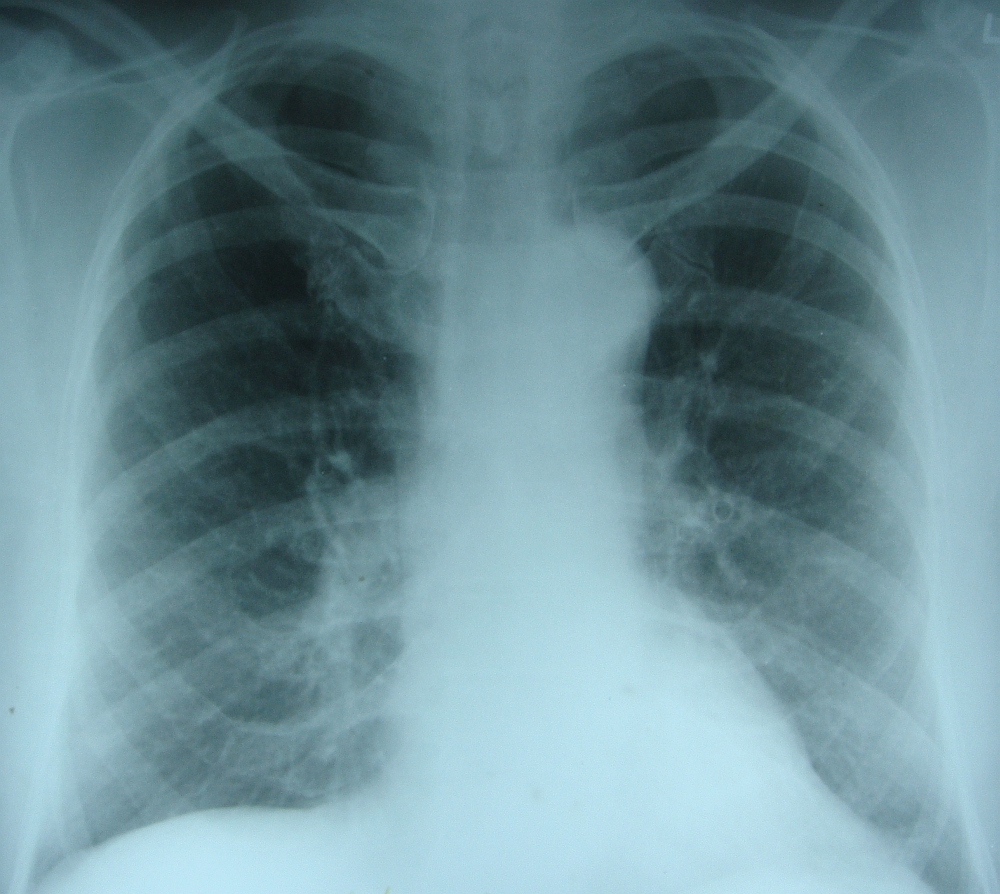 CXR after clearance of pulmonary edema