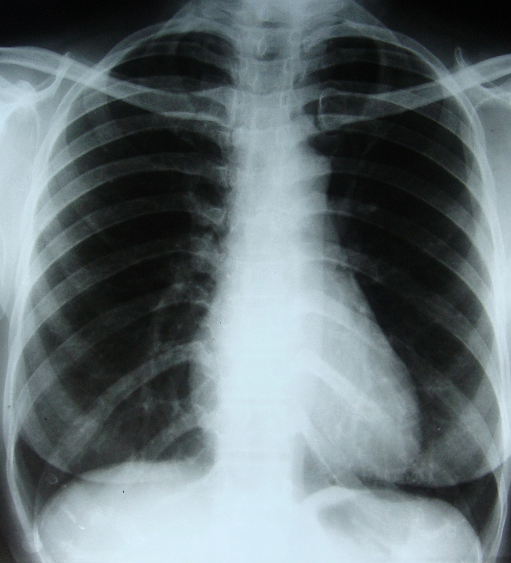 CXR after treatment of pericardial effusion