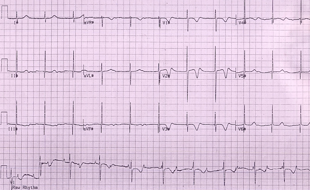 Congenital complete heart block - Stage 1 of exercise