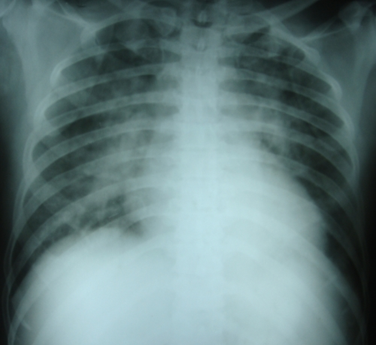 chest-x-ray-supine-view-with-pulmonary-congestion