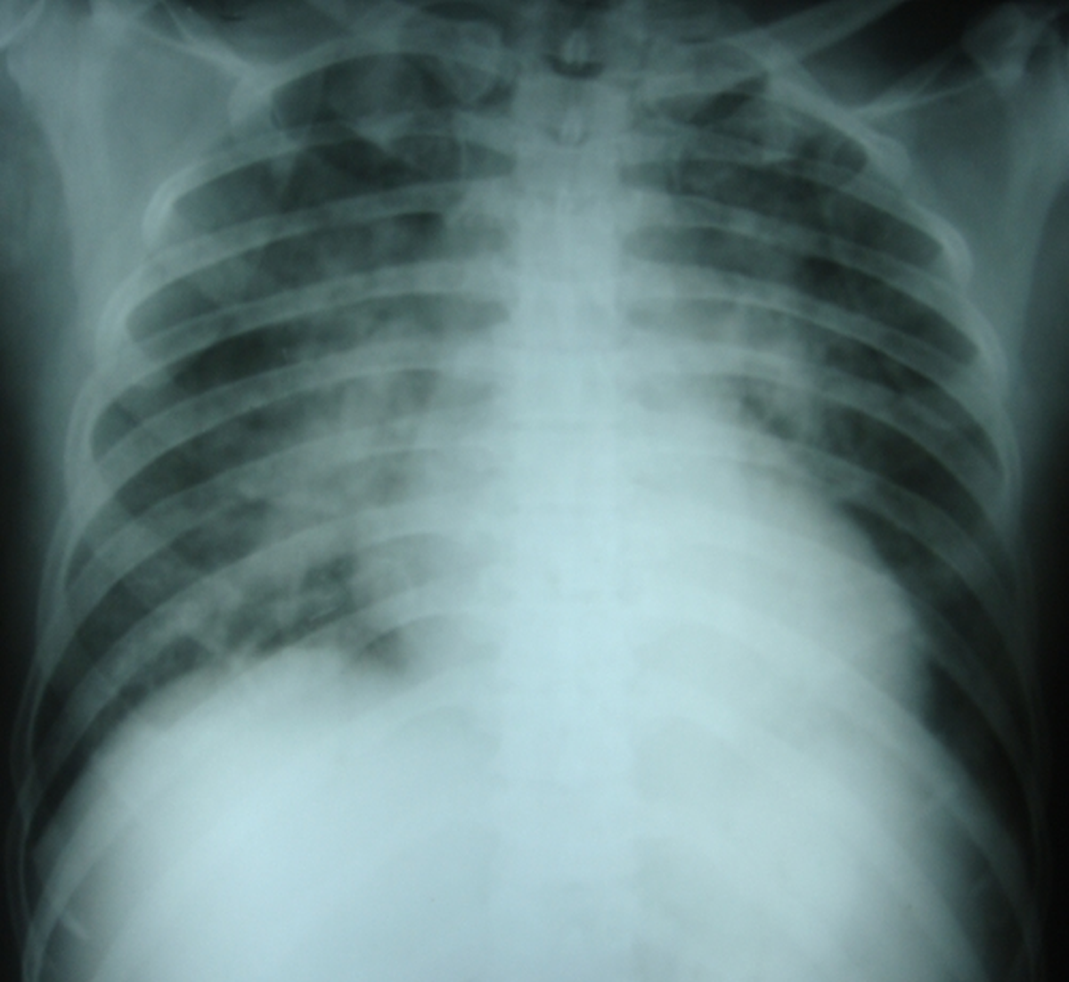 Chest X-ray supine view with pulmonary congestion