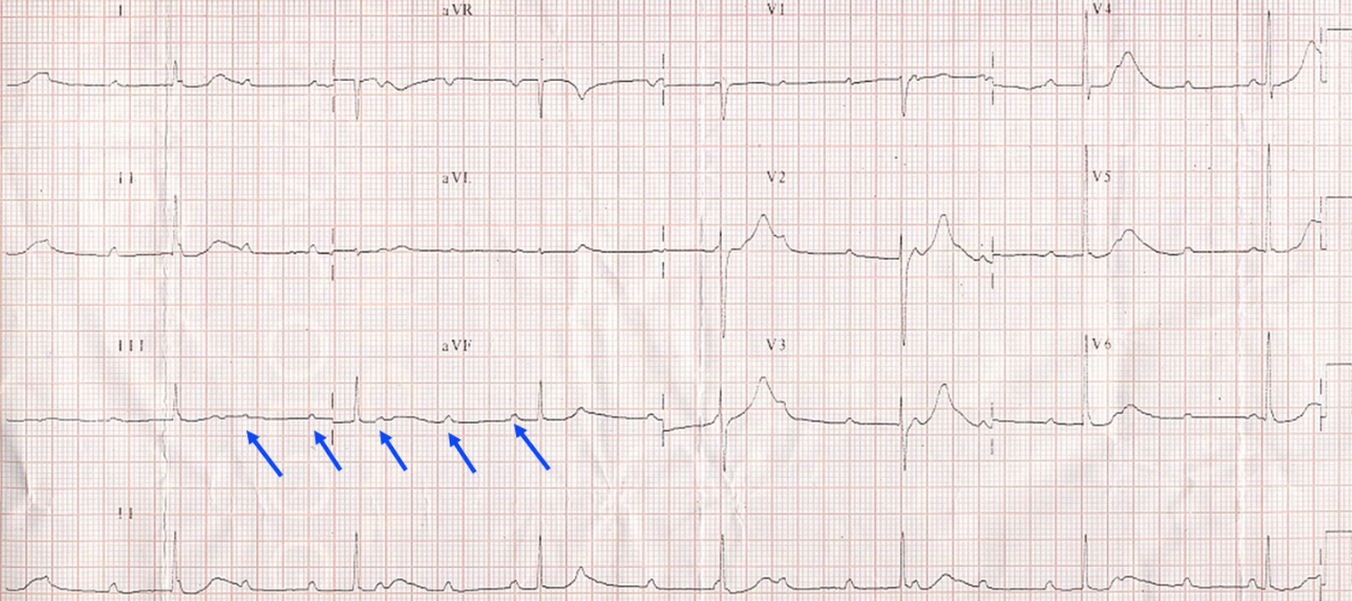 Complete heart block - narrow QRS