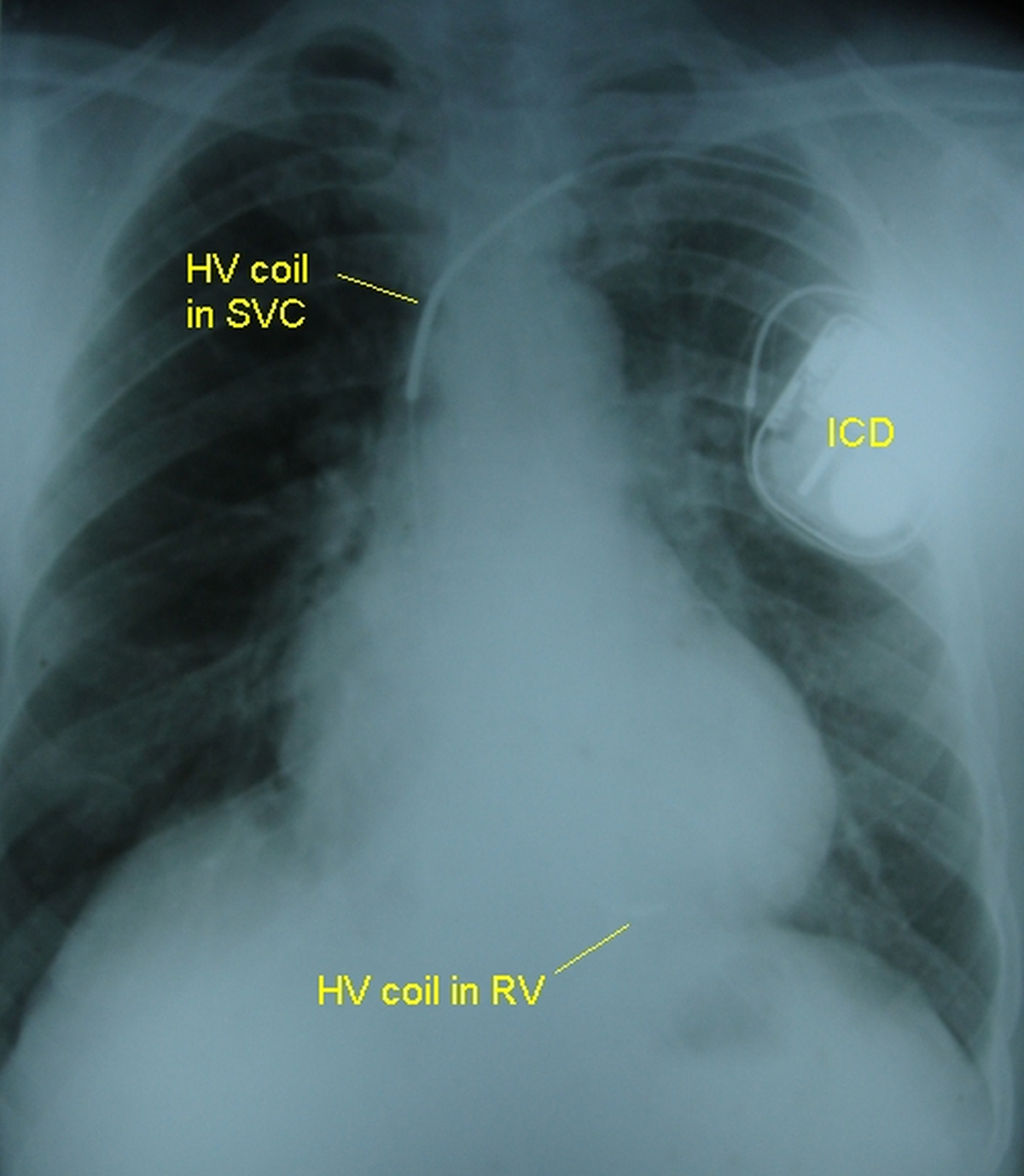 Implantable defibrillator high voltage coils on X-ray chest PA view - annotated