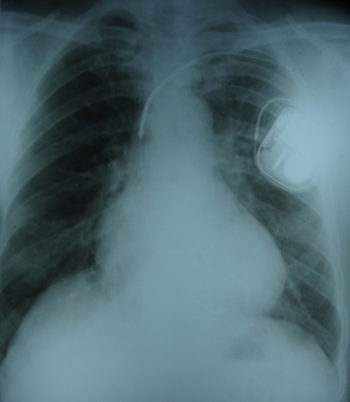 Implantable defibrillator high voltage coils on X-ray chest PA view