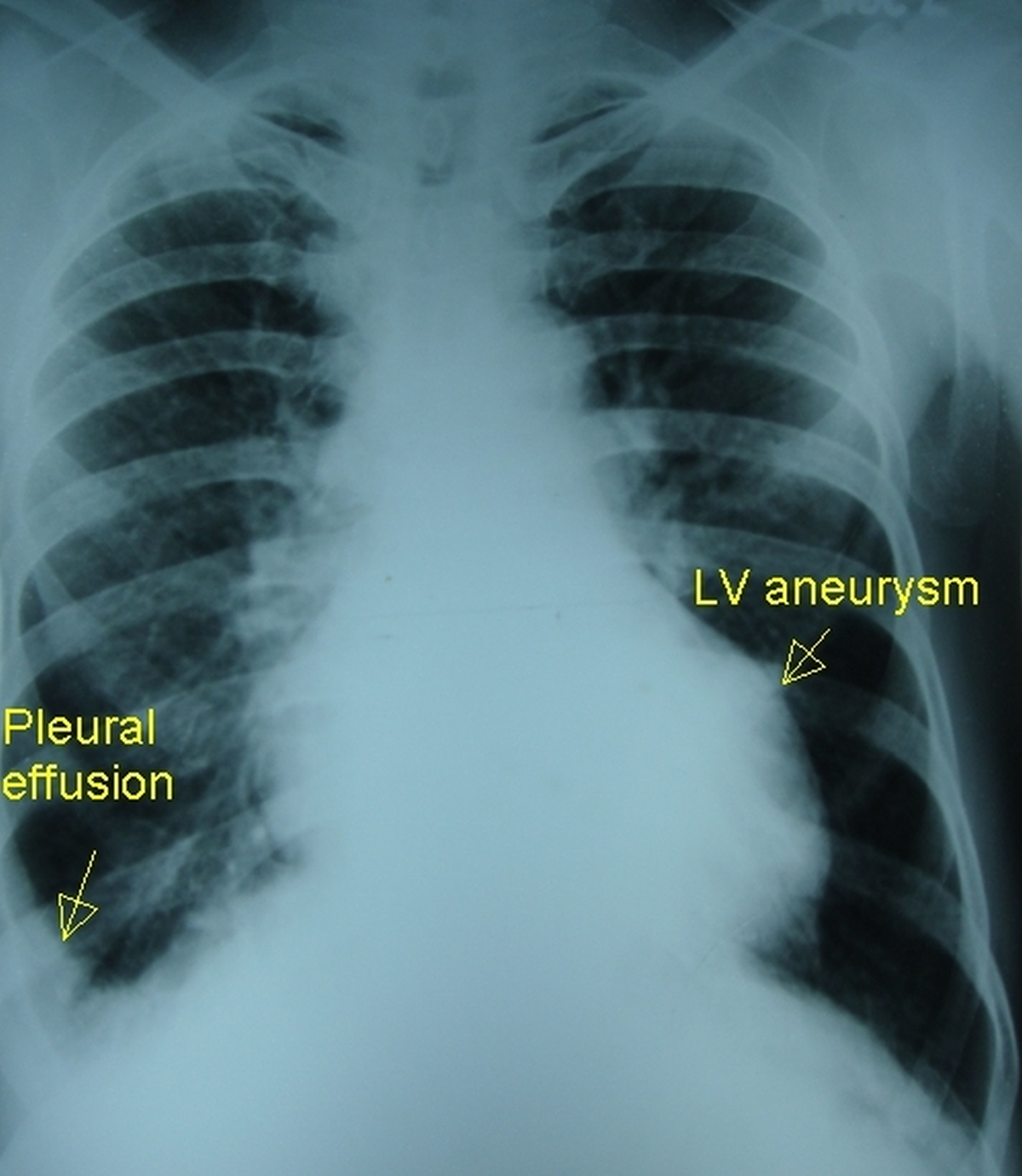 Left ventricular aneurysm and right pleural effusion - X-ray chest PA view - annotated