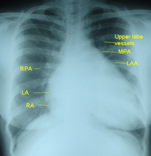 MS-PAH-annotated – All About Cardiovascular System and Disorders