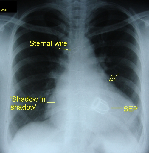 Prosthetic mitral valve – Starr Edward Prosthesis