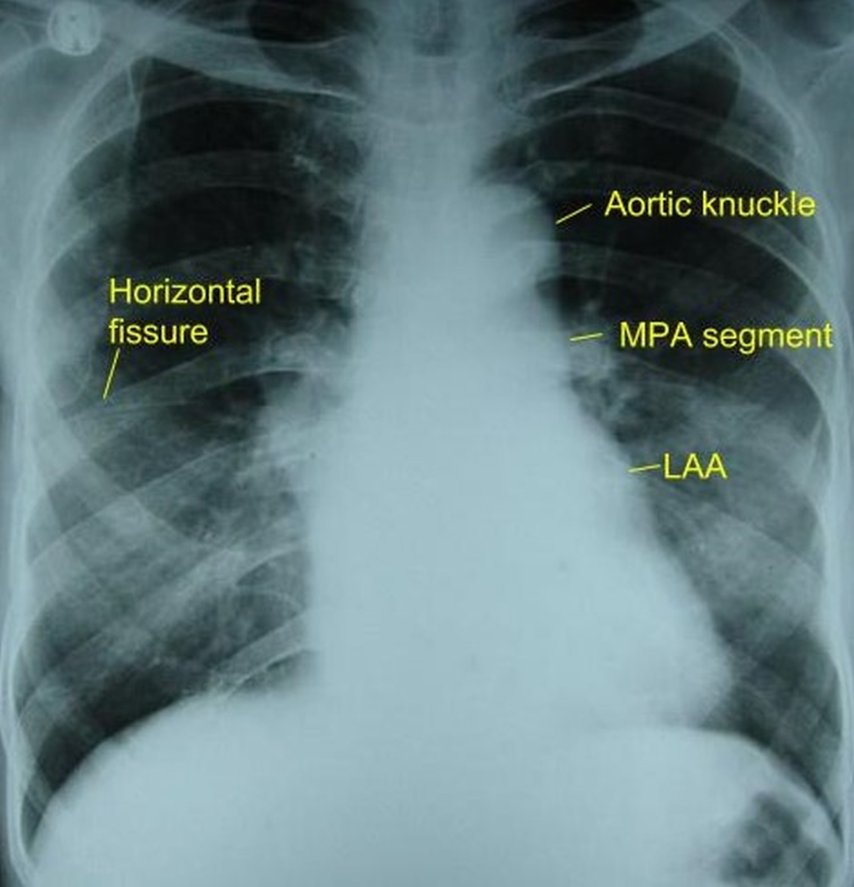 Mitral stenosis – X-ray chest PA view - annotated