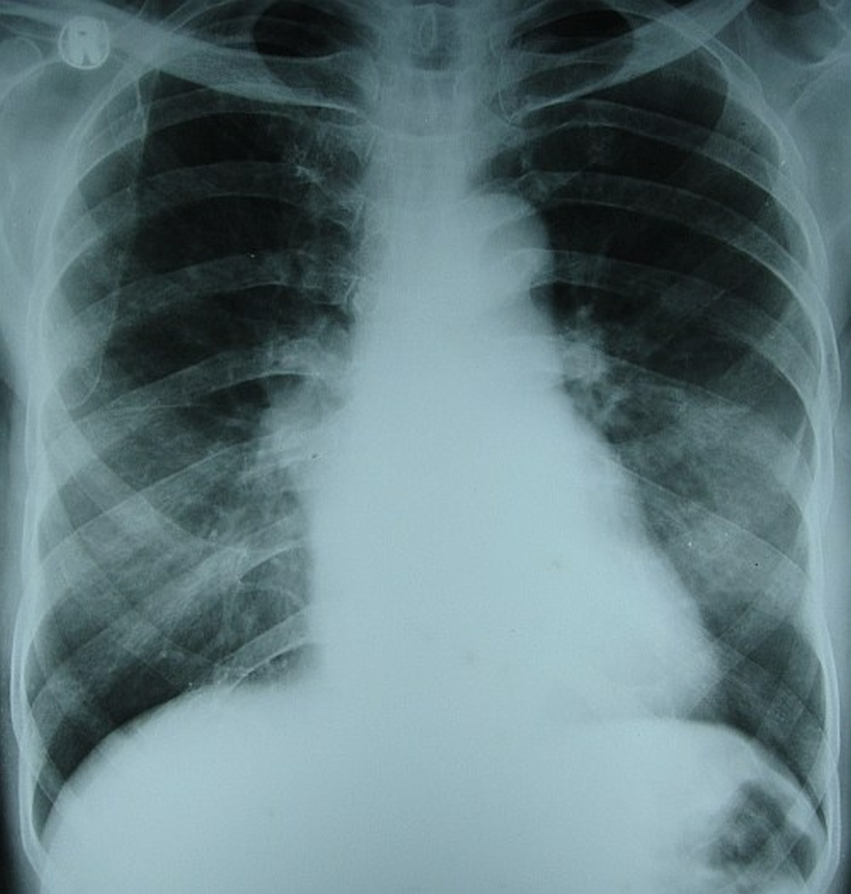 Mitral stenosis – X-ray chest PA view
