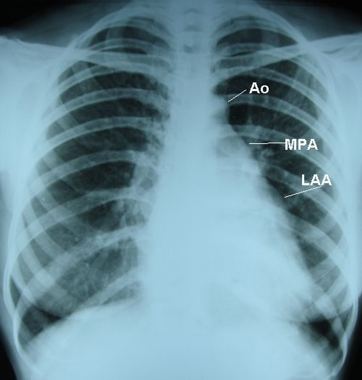 Mitral stenosis – straightening of left border - X-ray chest PA view - annotated