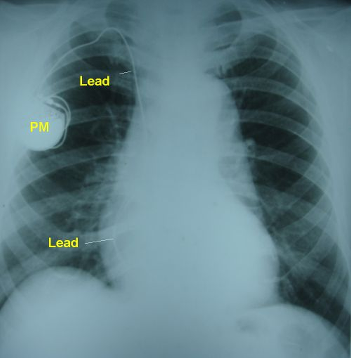Permanent pacemaker and dilated aorta on CXR