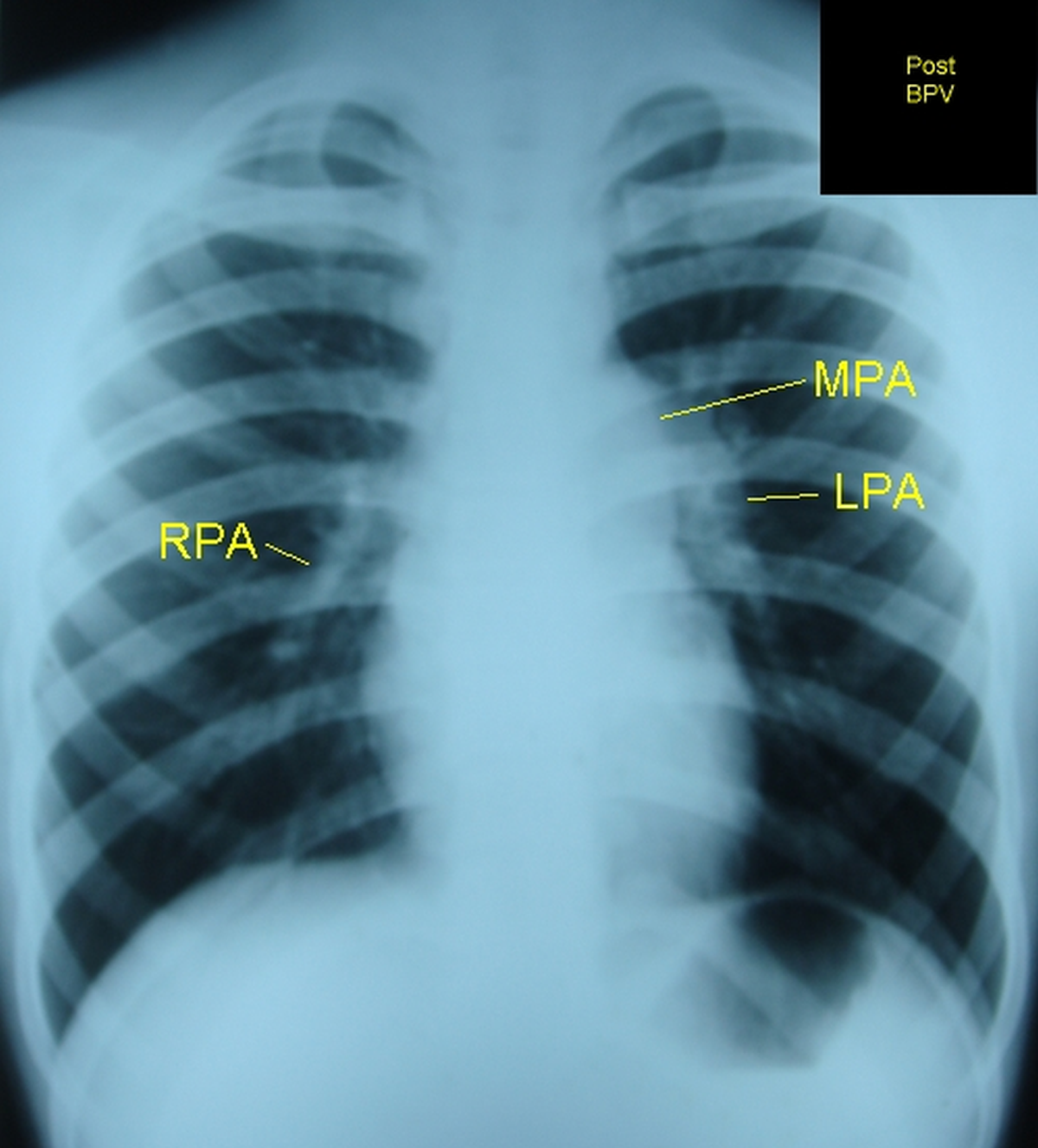 Post balloon pulmonary valvotomy (BPV) X-ray chest PA view - annotated