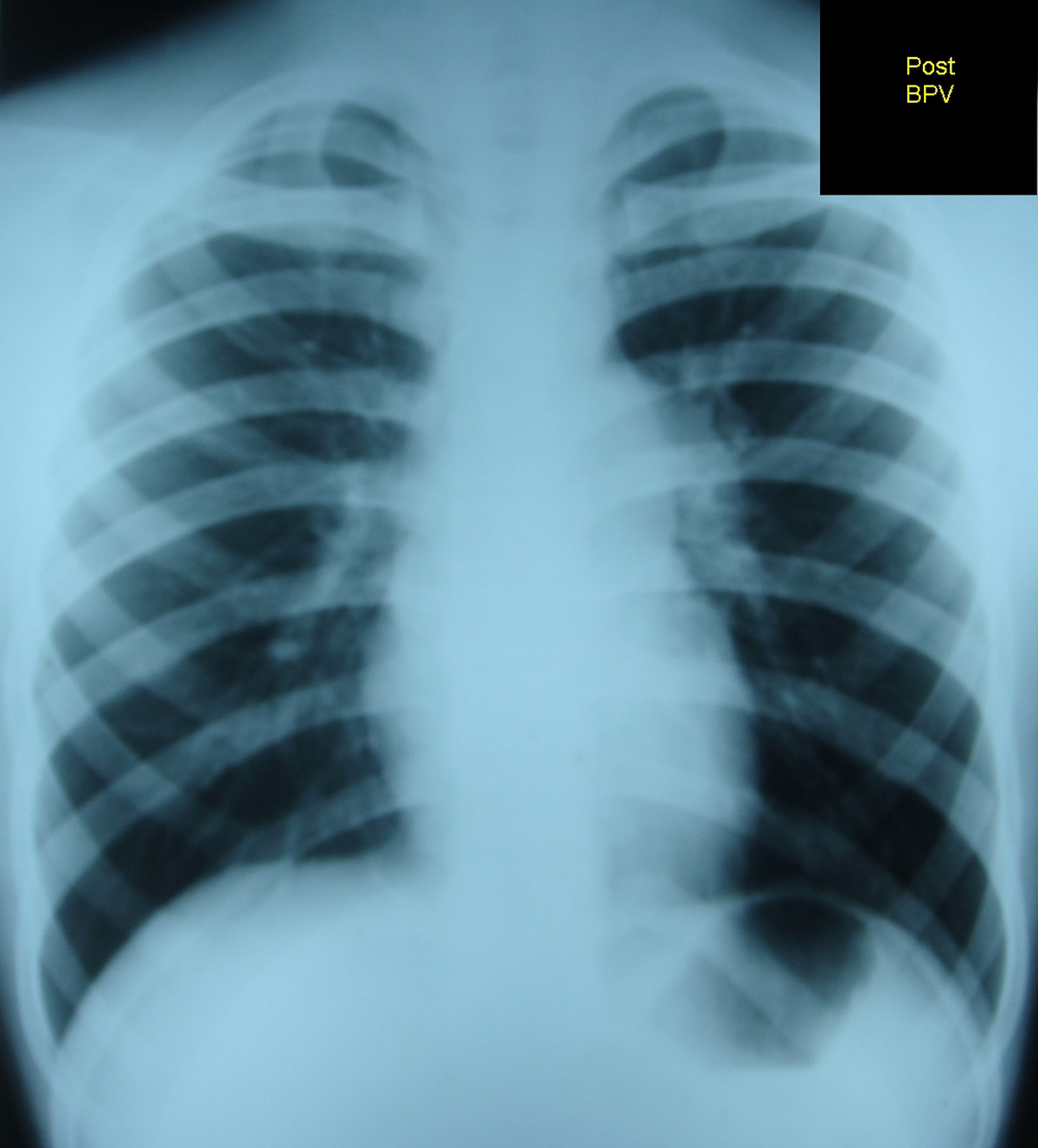 Post balloon pulmonary valvotomy (BPV) X-ray chest PA view