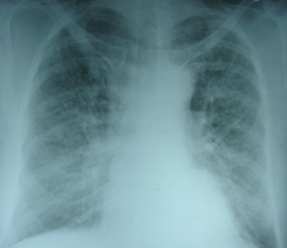 Pulmonary edema – X-ray chest PA view