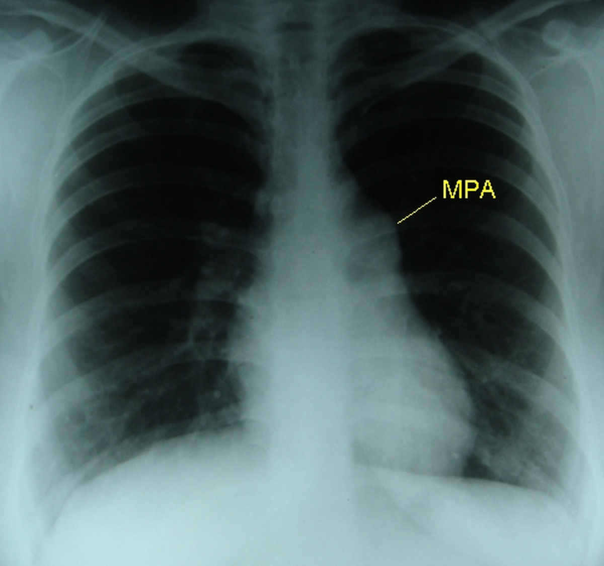 Pulmonary stenosis – X-ray chest PA view