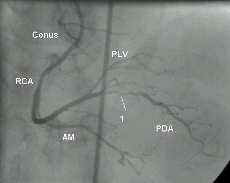 Right coronary angiogram in PA cranial view