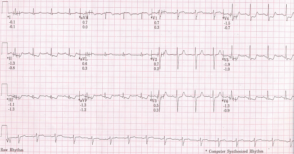 TMT recovery phase ECG at 6 minutes