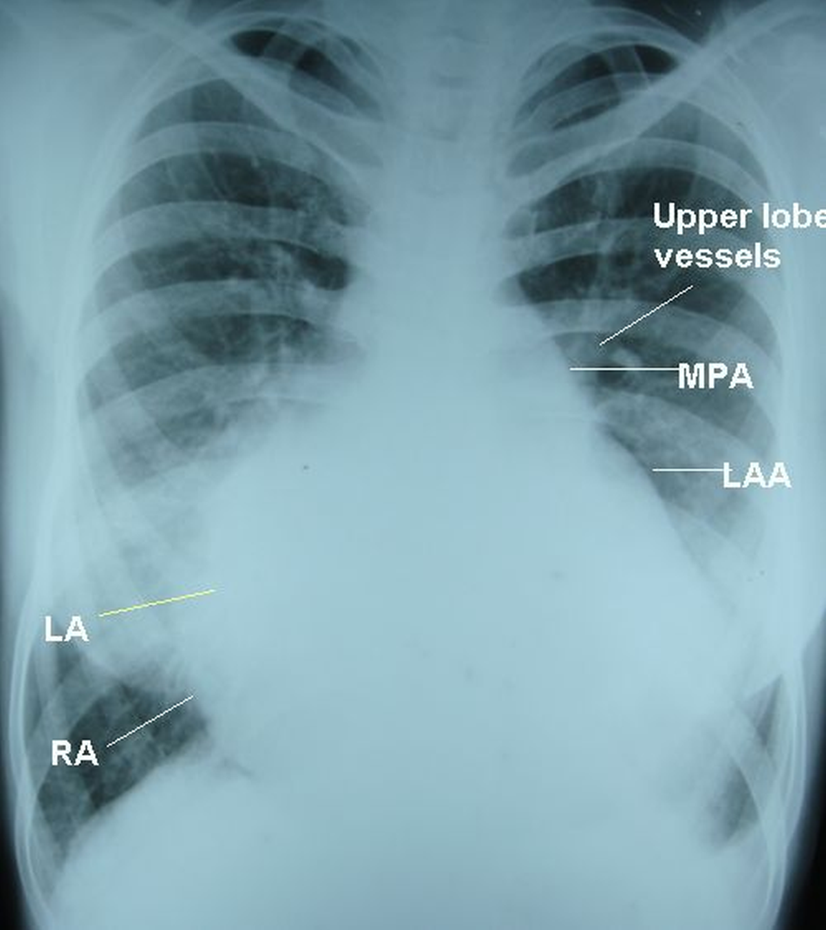 X-ray chest PA view in biventricular endomyocardial fibrosis - annotated