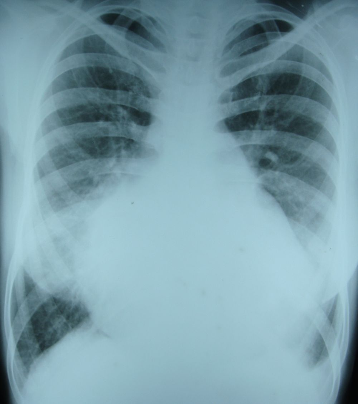 X-ray chest PA view in biventricular endomyocardial fibrosis