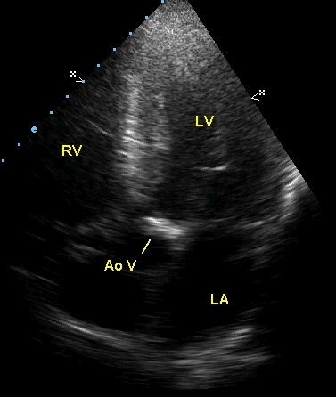 Apical five chamber view showing thickened aortic valve