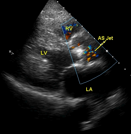 Colour flow mapping (CFM, color Doppler imaging) from parasternal long axis view in aortic stenosis