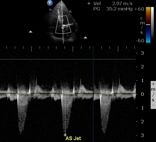 Aortic stenosis jet by continuous wave Doppler