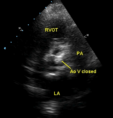 Parasternal short axis view at the level of the aortic valve