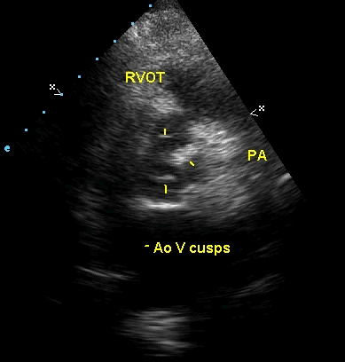 Parasternal short axis view in calcific aortic stenosis
