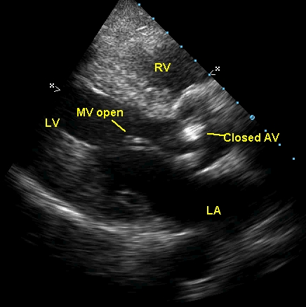 Diastolic frame in aortic stenosis from parasternal long axis view showing aortic valve in closed position