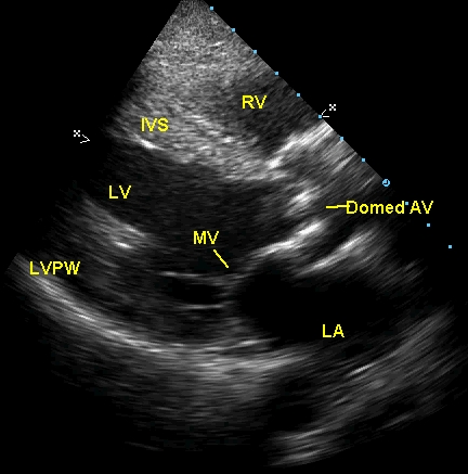 Echocardiogram in parasternal long axis view showing calcific aortic valve which domes in systole