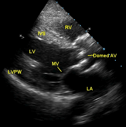 aortic valve echo